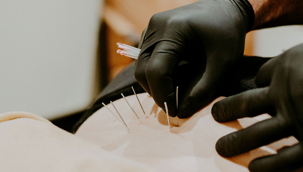 Dry needling treatment applied to the low back