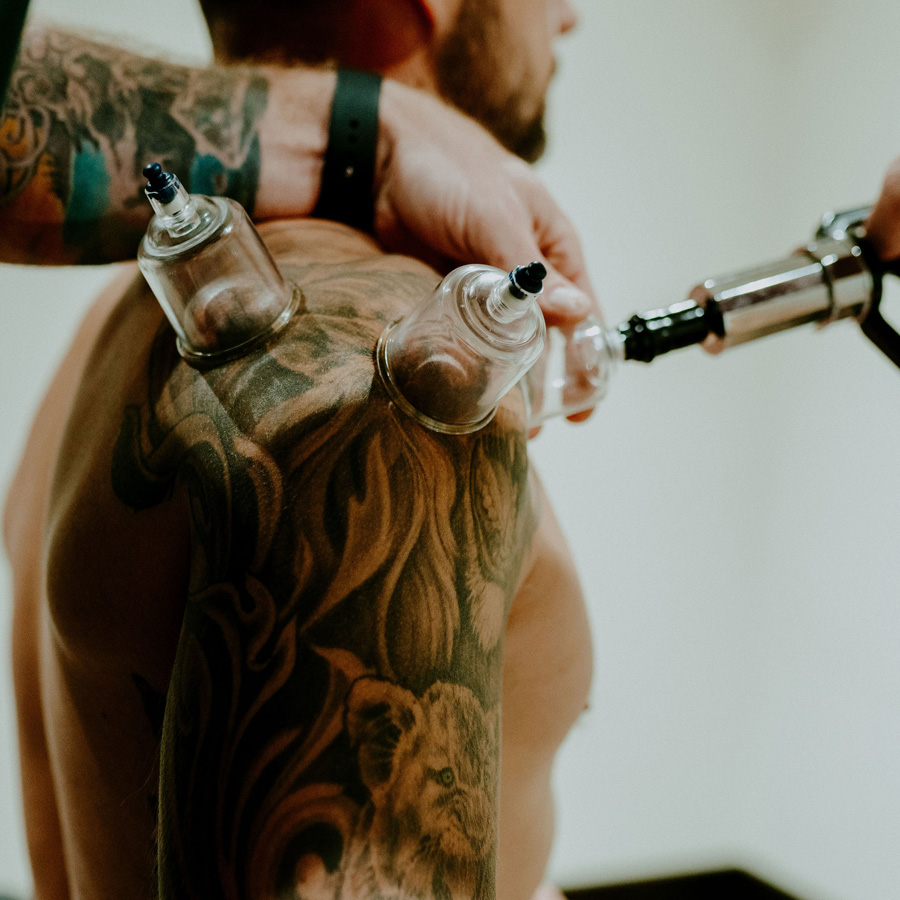 Cupping therapy treatment at Windy Ridge Chiropractic