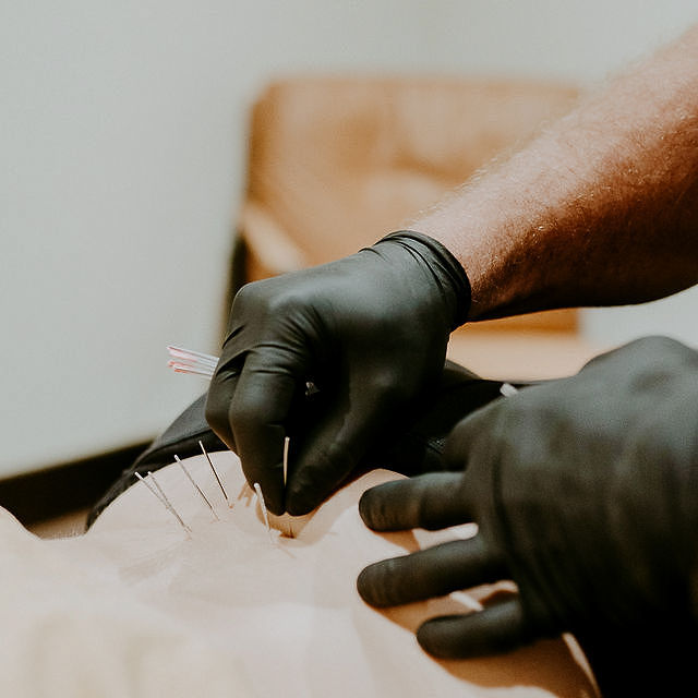 Dry needling therapy for soft tissue pain at Windy Ridge Chiropractic in Bozeman
